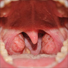 /public/images/201px-Throat_with_Tonsils_0012J.jpg